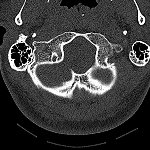 File:Normal CT of the cervical spine (Radiopaedia 53322-59305 Axial bone window 39).jpg