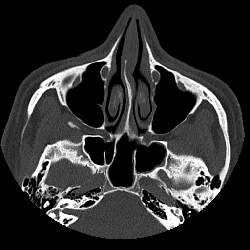 Normal CT paranasal sinuses (Radiopaedia 42286-45390 Axial bone window 66).jpg