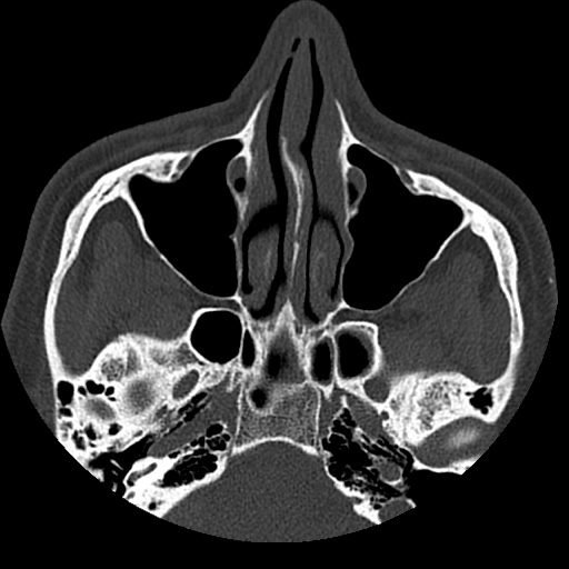 Normal CT paranasal sinuses (Radiopaedia 42286-45390 Axial bone window 70).jpg