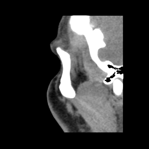 Normal CT paranasal sinuses (Radiopaedia 42286-45390 F 130).jpg