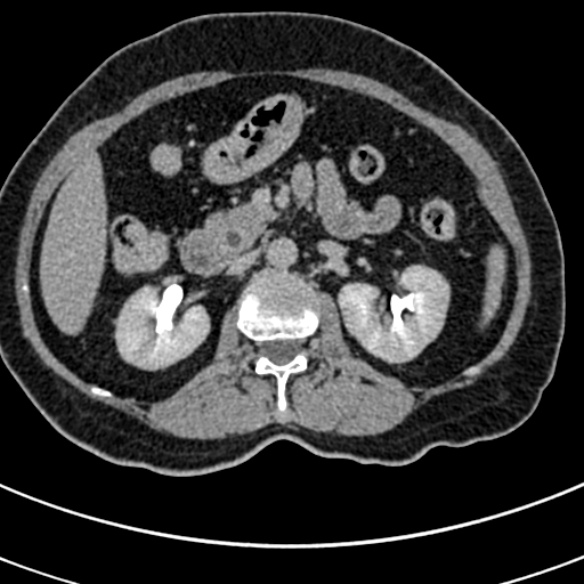 File:Normal CT split bolus study of the renal tract (Radiopaedia 48631-53634 Axial split bolus 68).jpg