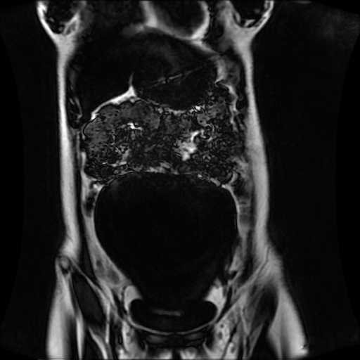 Normal MRI abdomen in pregnancy (Radiopaedia 88001-104541 N 44).jpg