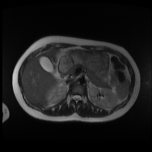 Normal MRI abdomen in pregnancy (Radiopaedia 88003-104546 Axial T2 6).jpg