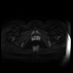 Normal MRI abdomen in pregnancy (Radiopaedia 88005-104548 Axial DWI 79).jpg