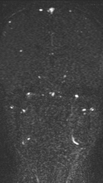 Normal MRI brain with MRV- teenager (Radiopaedia 49425-54553 Coronal MRV 136).jpg