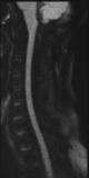 File:Normal MRI cervical spine (infection protocol) (Radiopaedia 53916-60039 Sagittal DWI 22).png