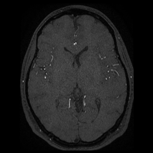 Normal brain MRA (Radiopaedia 41046-43793 Axial MRA 23).png