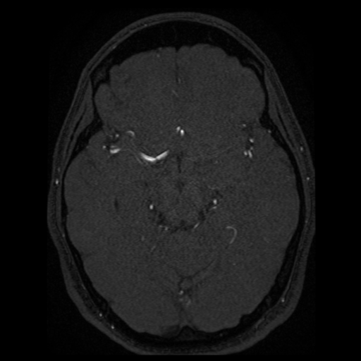Normal brain MRA (Radiopaedia 41046-43793 Axial MRA 47).png