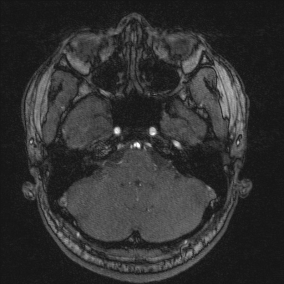 Normal brain MRI including MRA (Radiopaedia 48748-53763 Axial MRA 40).jpg