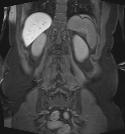 File:Normal hepatobiliary phase liver MRI (Radiopaedia 58968-66230 B 10).jpg