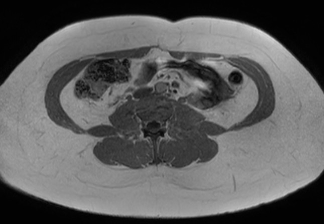 File:Normal liver MRI with Gadolinium (Radiopaedia 58913-66163 Axial T1 in-phase 1).jpg