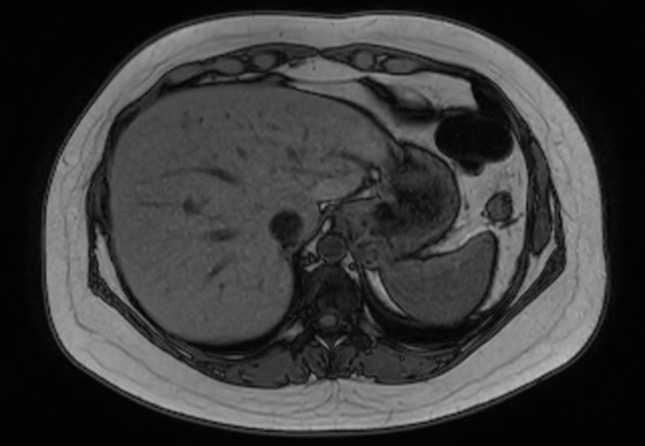 File:Normal liver MRI with Gadolinium (Radiopaedia 58913-66163 B 25).jpg