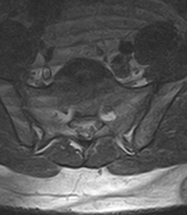 Normal lumbar spine MRI - low-field MRI scanner (Radiopaedia 40976-43699 Axial T2 94).jpg