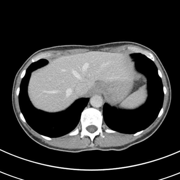 File:Normal multiphase CT liver (Radiopaedia 38026-39996 C 9).jpg