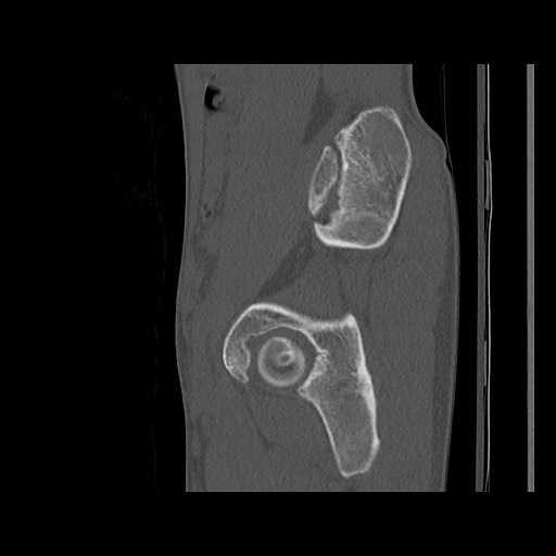 Normal pelvis (Radiopaedia 51473-57238 Sagittal bone window 105).jpg