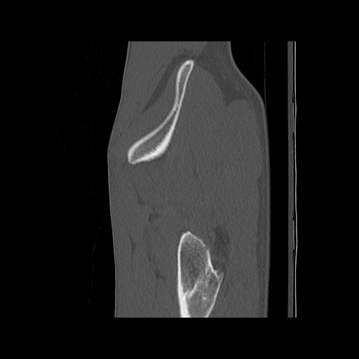 Normal pelvis (Radiopaedia 51473-57238 Sagittal bone window 22).jpg