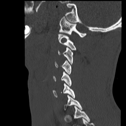 File:Normal trauma cervical spine (Radiopaedia 41017-43760 Sagittal bone window 35).png