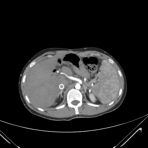 File:Nutmeg liver- Budd-Chiari syndrome (Radiopaedia 46234-50635 A 24).png