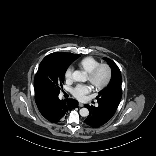 Obstructing sigmoid adenocarcinoma (Radiopaedia 58465-65619 A 4).jpg