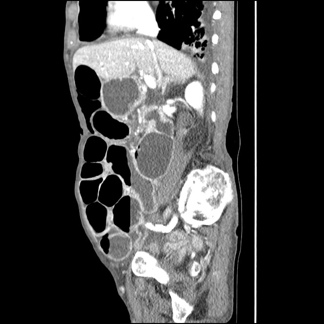 Obturator hernia causing small bowel obstruction (Radiopaedia 65522-74612 C 64).jpg