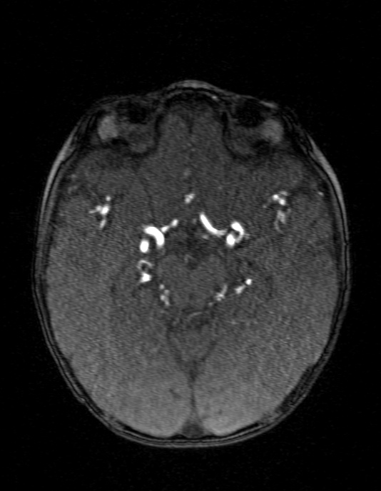 Occipital horn syndrome (Radiopaedia 14255-14129 MRA 69).jpg