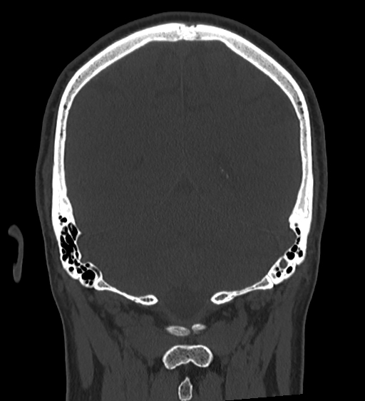 Occipital spur and Currarino type A atlas anomaly (Radiopaedia 87027-103285 Coronal bone window 107).jpg