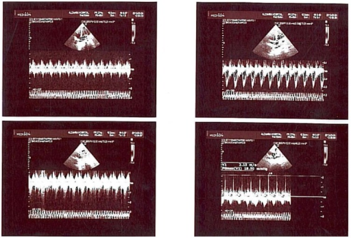Tachycardia-induced cardiomyopathy-Panel representative trans thoracic echocardiography