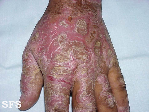 File:Psoriasis (Dermatology Atlas 10).jpg