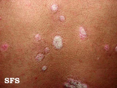 File:Psoriasis (Dermatology Atlas 16).jpg