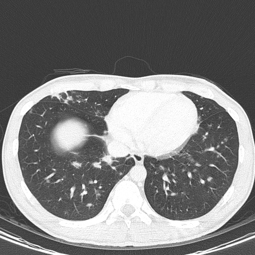 AIDS-related Kaposi sarcoma (Radiopaedia 85247-100811 Axial lung window 130).jpg