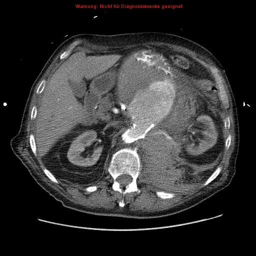 Abdominal aortic aneurysm- extremely large, ruptured (Radiopaedia 19882-19921 Axial C+ arterial phase 22).jpg