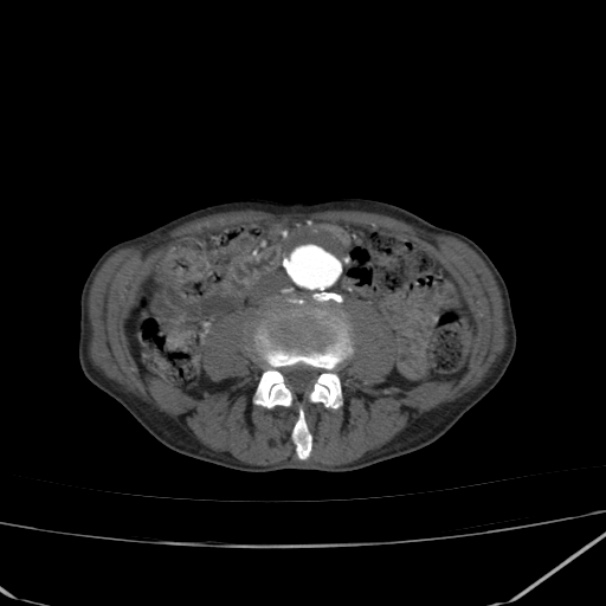 Abdominal aortic aneurysm (Radiopaedia 23703-23856 Axial C+ arterial phase 48).jpg