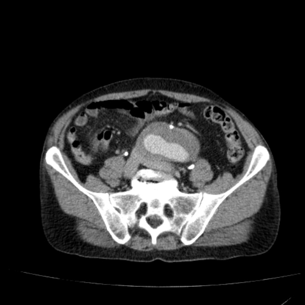 Abdominal aortic aneurysm (Radiopaedia 29248-29660 Axial C+ portal venous phase 44).jpg
