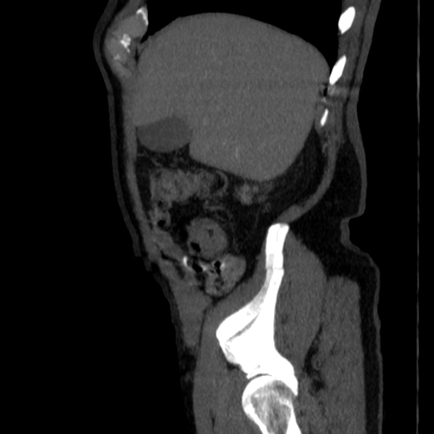 Abdominal aortic aneurysm (Radiopaedia 29248-29660 Sagittal C+ arterial phase 8).jpg