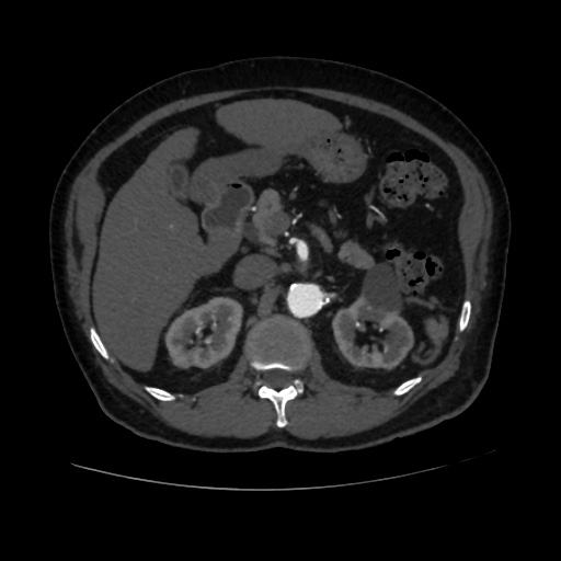 File:Abdominal aortic aneurysm (Radiopaedia 57318-64259 Axial C+ arterial phase 24).jpg