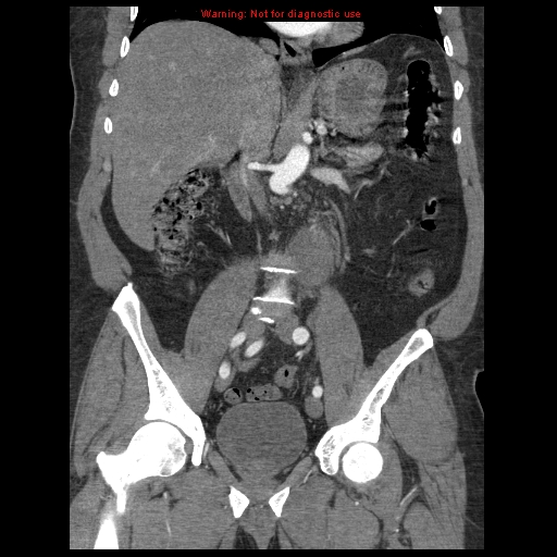 Abdominal aortic aneurysm (Radiopaedia 8190-9038 Coronal C+ arterial phase 68).jpg