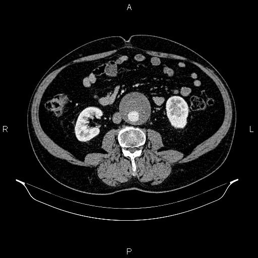 Abdominal aortic aneurysm (Radiopaedia 83094-97462 Axial renal cortical phase 104).jpg