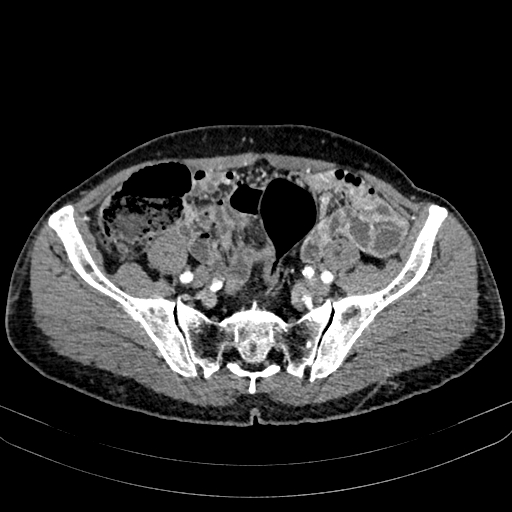 Abdominal aortic aneurysm (Radiopaedia 83581-98689 Axial C+ arterial phase 90).jpg