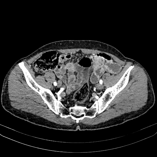 Abdominal aortic aneurysm (Radiopaedia 83581-98689 Axial C+ arterial phase 94).jpg