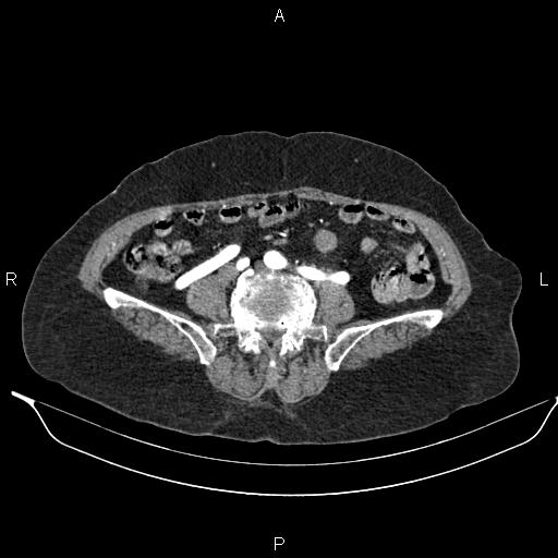 File:Abdominal aortic aneurysm (Radiopaedia 85063-100606 Axial C+ arterial phase 49).jpg