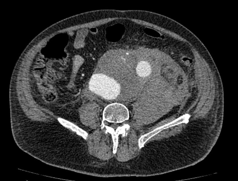 Abdominal aortic aneurysm rupture (Radiopaedia 54179-60362 Axial C+ portal venous phase 14).jpg