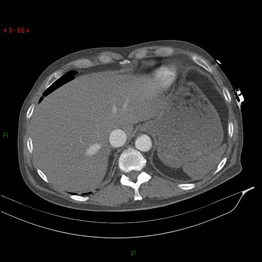 File:Abdominal aortic aneurysm rupture with aortocaval fistula (Radiopaedia 14897-14841 Axial C+ arterial phase 68).jpg