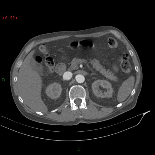File:Abdominal aortic aneurysm rupture with aortocaval fistula (Radiopaedia 14897-14841 Axial C+ arterial phase 93).jpg