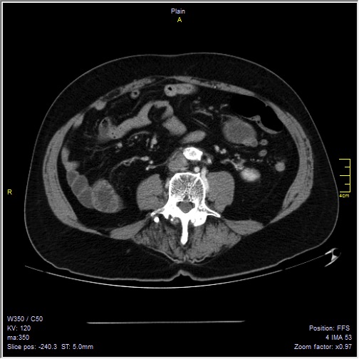 Abdominal aortic aneurysm with thrombus fissuration (Radiopaedia 47340-51926 Axial C+ arterial phase 37).jpg