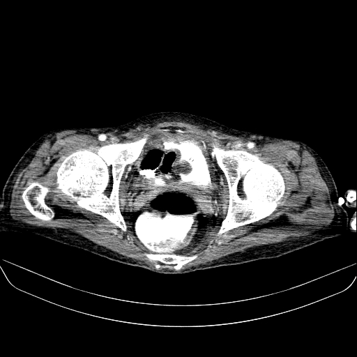 File:Abdominal collection due to previous cecal perforation (Radiopaedia 80831-94320 Axial C+ portal venous phase 194).jpg