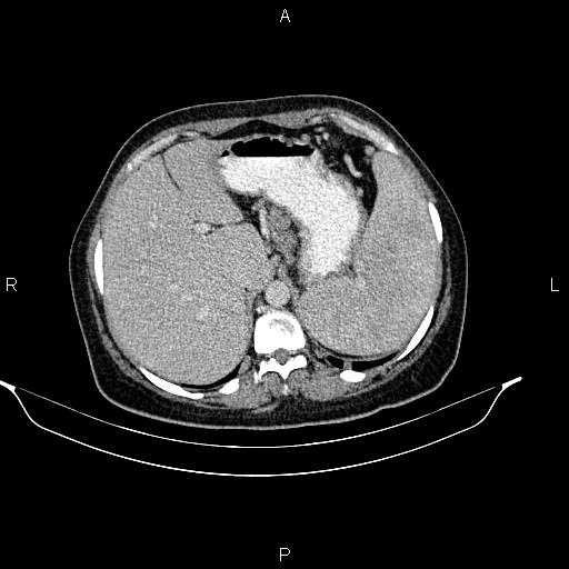 Abdominal lymphoma with sandwich sign (Radiopaedia 84378-99704 Axial C+ portal venous phase 12).jpg