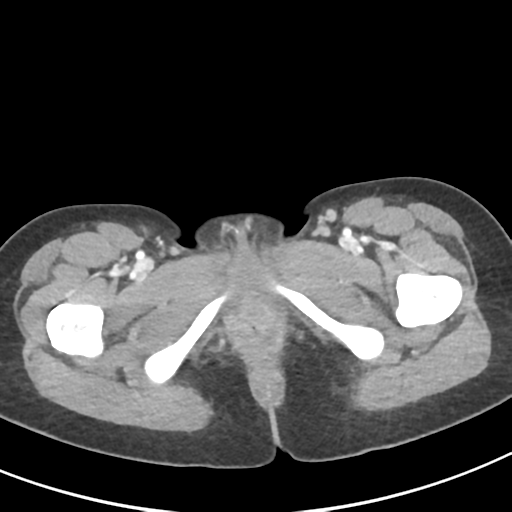 File:Abdominal tuberculosis and appendicitis (Radiopaedia 65631-74735 Axial C+ portal venous phase 75).png