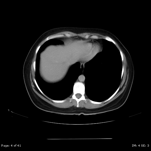 File:Abdominal wall endometriosis (Radiopaedia 25723-25885 Axial C+ portal venous phase 4).jpg
