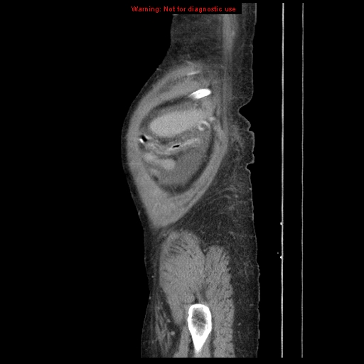 Abdominal wall hematoma (Radiopaedia 9427-10112 Sagittal C+ portal venous phase 11).jpg
