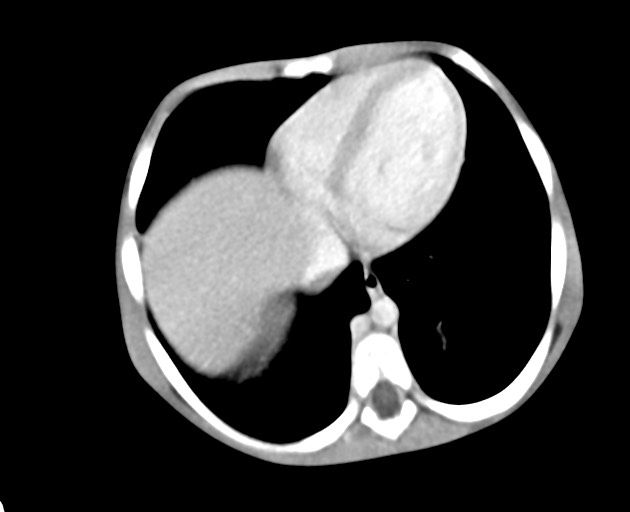 Abdominopelvic rhabdomyosarcoma (Radiopaedia 78356-90984 Axial C+ portal venous phase 34).jpg